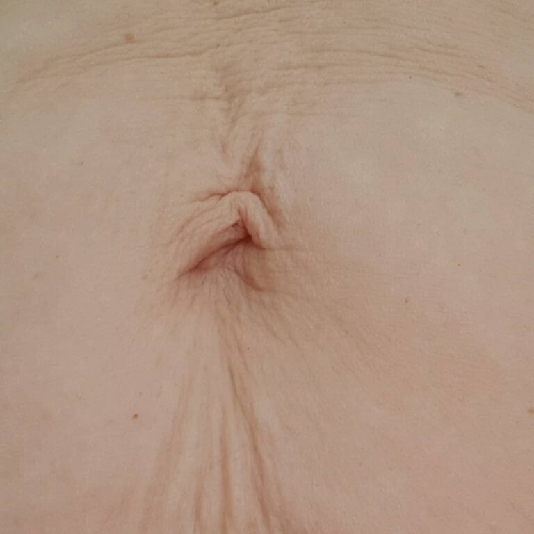Mezoterapia – brzuszek po ciąży