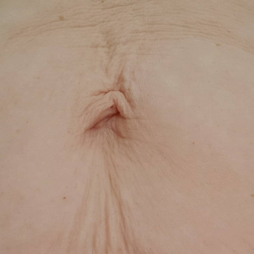 Deyneka Salon Kosmetyczny - Mezoterapia - Brzuszek po ciąży 1