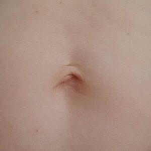 Deyneka Salon Kosmetyczny - Mezoterapia - Brzuszek po ciąży 2 Deyneka Salon Kosmetyczny - Mezoterapia - Brzuszek po ciąży 2