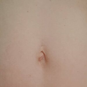 Deyneka Salon Kosmetyczny - Mezoterapia - Brzuszek po ciąży 3 Deyneka Salon Kosmetyczny - Mezoterapia - Brzuszek po ciąży 3