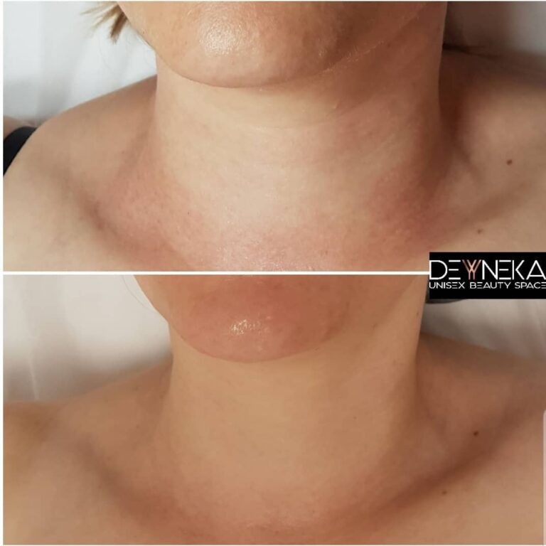 Lifting bez skalpela – Mezoterapia – szyja